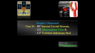 Ultrasound Case 95  Subclavian Steal  Ulcerated Plaque [upl. by Eedyak957]