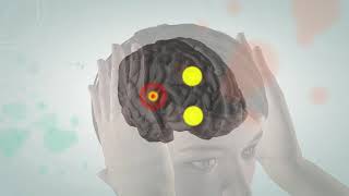 Animated video illustrating the pathophysiology of migraine [upl. by Barbour]