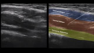 Transverse Abdominus Plane Block TAP Ultrasound 112020 [upl. by Ramsa]