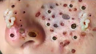 Soothing Blackhead Extraction ASMR Compilation PART 2 [upl. by Ayel]