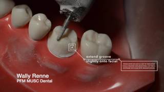 PFM Crown Prep and animation for Dental Students [upl. by Jerrylee]