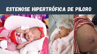 Alerta Estenose Hipertrófica de Piloro estenosehipertroficadepiloro vomitos bebe saullostan [upl. by Eyla57]