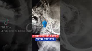 What is adenoids Does it lead to snoring How to treat it Dr Krishna Koirala Pokhara Nepal [upl. by Yolanthe641]