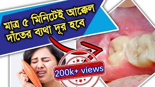 ৫ মিনিটেই আক্কেল দাঁতের ব্যথা দূর হবে  wisdom tooth pain  akkel dater betha DentalHealthTips [upl. by Veta]