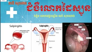 ជំងឺរលាកដៃស្បូន Salpingitis វេជ្ជបណ្ឌិតណាំ សុខណាង [upl. by Rehpretsirhc]