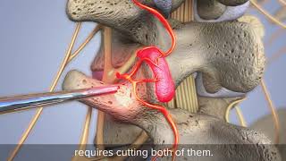 Direct Visualized Rhizotomy is an endoscopic procedure for back pain  Animation [upl. by Coffey792]