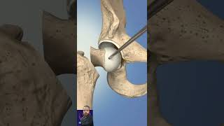 Hip joint replacement surgery kaise hoti hai  shortvideo video youtube hipjoint [upl. by Gayelord]