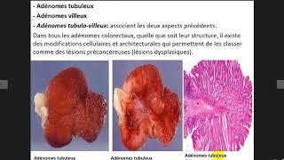 tumeurs épithélials 1 [upl. by Milissent394]