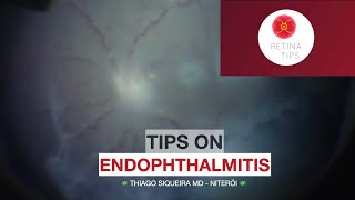 Tips on Endophthalmitis [upl. by Randa]