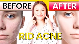 The FASTEST Way to Rid Acne Forever [upl. by Ailil]