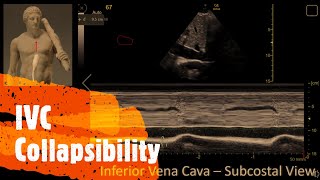 Estimate the Right Atrial Pressure using the IVC Perioperative amp Critical Care ECHO POCUS [upl. by Alroy]