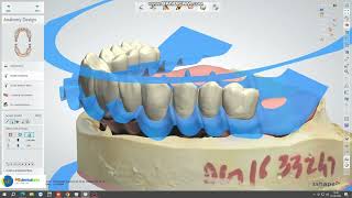 Digital Denture With Ivotion Launched by M S DENTAL ARTS DENTAL LAB [upl. by Ettelloc]