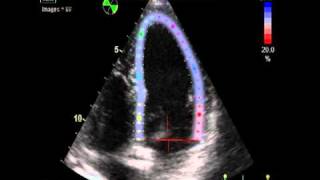 IS EJECTION FRACTION NORMAL 2  STRAIN VALUE  ECHOCARDIOGRAPHY cardiac ultrasound [upl. by Chil]