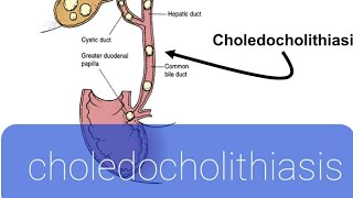 How to Pronounce quotCholedocholithiasisquot [upl. by Nalym]