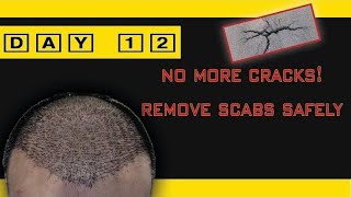 FUE Hair Transplant Day 12 Post Op  No Scabs and Cracks [upl. by Iden]