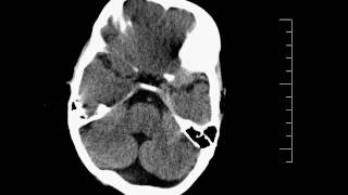 Agenesis Corpus Callosum  Dandy Walker CT Head [upl. by Nnasus]