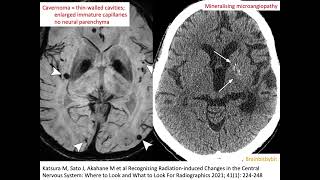 67 Radiation induced cavernoma and mineralising microangiopathy popcorn capillary teleangiectasia [upl. by Ilram137]