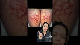 Erythema Ab Igne Beware skincare dermatology spaceheaters [upl. by Eninahs]