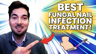 How To Get Rid Of A Fungal Nail Best Treatment [upl. by Washington]