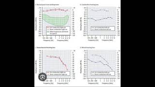 Audiometric fundamentals [upl. by Lynus]