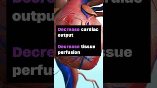 How to ace Cardiac Tamponade in nursing school and NCLEX nursingschooltips [upl. by Intirb292]