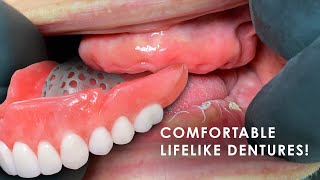 How to Create Comfortable Lifelike Dentures [upl. by Katzman703]