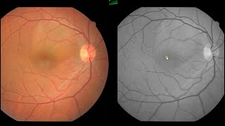 Central Serous Retinopathy Case [upl. by Acinnej91]