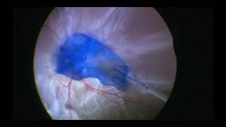 Vitrectomy for Retinal Detachment with PVR  Retinal Detachment  Dr Manish Nagpal [upl. by Hebe]