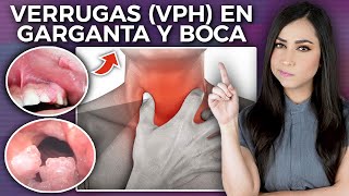 VPH oral SÍNTOMAS y TRATAMIENTO l Papilomatosis laríngea l Dra Pau Zúñiga👩🏻‍⚕️ [upl. by Eibba387]