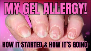 My Gel Nail Polish Allergy  How Its Going amp A Quick Manicure [upl. by Hallett]