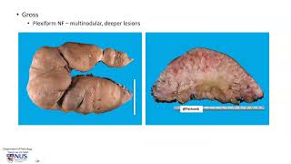 Skin  Neurofibroma Gross pathology [upl. by Johppah]