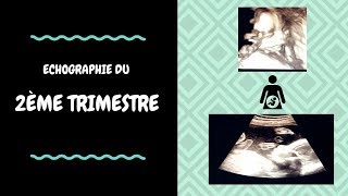 ECHOGRAPHIE DU 2ème TRIMESTRE [upl. by Gloria233]