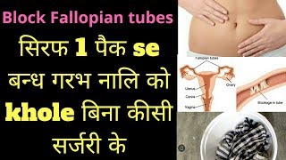 fellopian tube blockage in hindi  fellopian tube blockage treatment heenhaealth [upl. by Tarah]