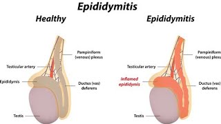 Epididymitis treatment in hindi or english [upl. by Charbonneau]