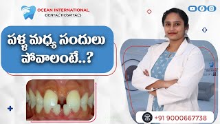 పళ్ళ మధ్య సందులు  How to Fill Gaps Between Teeth in Telugu  Ocean International Dental Hospitals [upl. by Kiri]