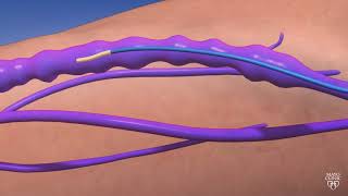 Guiding Light An Animated Journey through Endovenous Thermal Ablation [upl. by Nylirac]