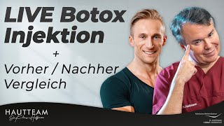 LIVE Botox Injektion bei Patient  VorherNachherVergleich beim Mann [upl. by Seve]