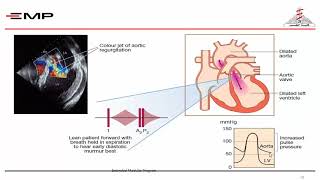 AORTIC VALVE DISEASE By DrYasser Alaaeldin Mahmoud [upl. by Leelaj]