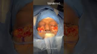 Lower transconjuctival blepharoplasty  Dr Bashar Bizrah LondonDubai [upl. by Akinnor67]