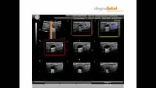 ECOGRAFIA DE MAMA 3D Y 4D DIAGNOSALUD [upl. by Forkey]