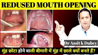 सिर्फ ये गलती कभी नहीं करनी चहिए । limited mouth opening । Sub Mucous fibrosis ।OSMF ।dramitkdubey [upl. by Clyve]