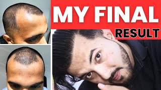 Journey Of My Full Hair Transplant Result After 1 Year  Best Hair Transplant Result In India 2023 [upl. by Semadar]