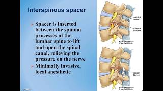 Lumbar Spinal Stenosis  Diagnosis and Treatment Options [upl. by Ches753]