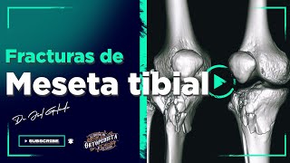 TIBIAL POSTERIOR fortalecimiento mediante ejercicios concéntricos [upl. by Ambrogio]