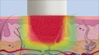 Swift Verruca Microwave Treatment Process [upl. by Artek]