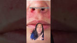 Dermatologist explains Perioral Dermatitis perioraldermatitis [upl. by Ohaus314]