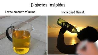 Diabetes insipidus Symptoms causes and treatment Diabetes insipidus vs diabetes mellitus [upl. by Anuahsed]