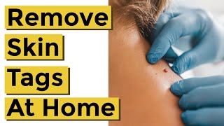 How to Quickly and Easily Remove Skin Tags at Home Using Things You Already Own [upl. by Nosnek]