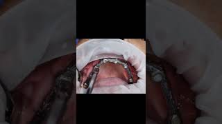 Avoiding zygomatic dental implant surgery by 3BTi B protocol post 6 months healing statusshorts [upl. by Orlov44]