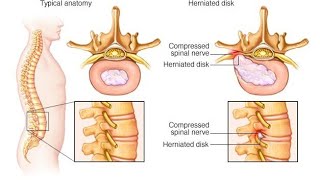 Back pain kamar Dard L4 L5 L5 S1 disc mein problem thi vah Dr AP GAUTAM physiotherapy se thik kardi [upl. by Akela]